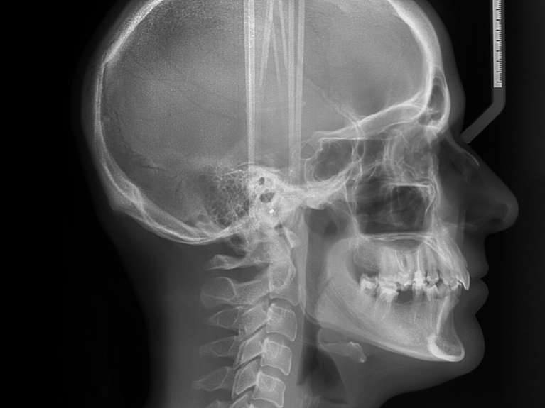 Ceph X-Ray in hampton park